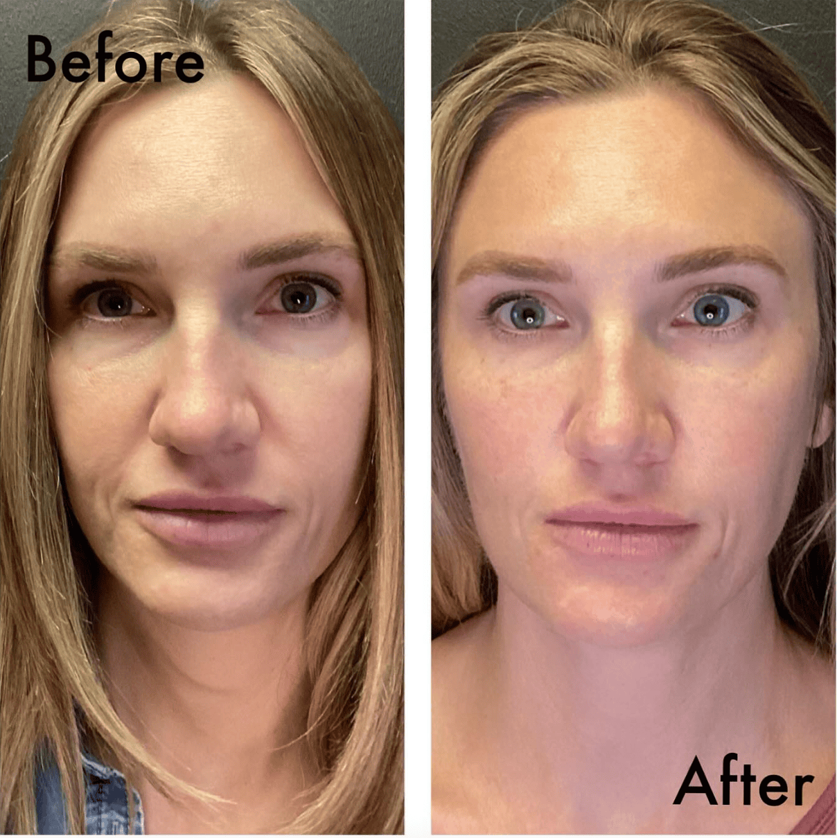Forehead lines before/after – smoother after 2 weeks